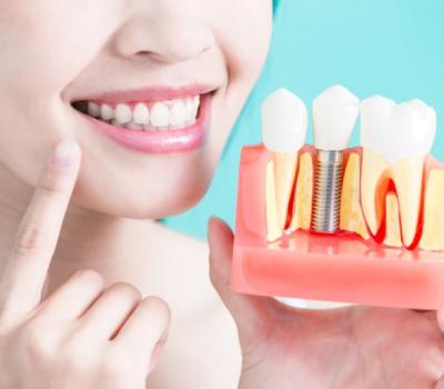 Root canal as an alternative to tooth loss