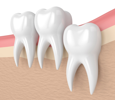 Experienced wisdom teeth dentist hawthorn